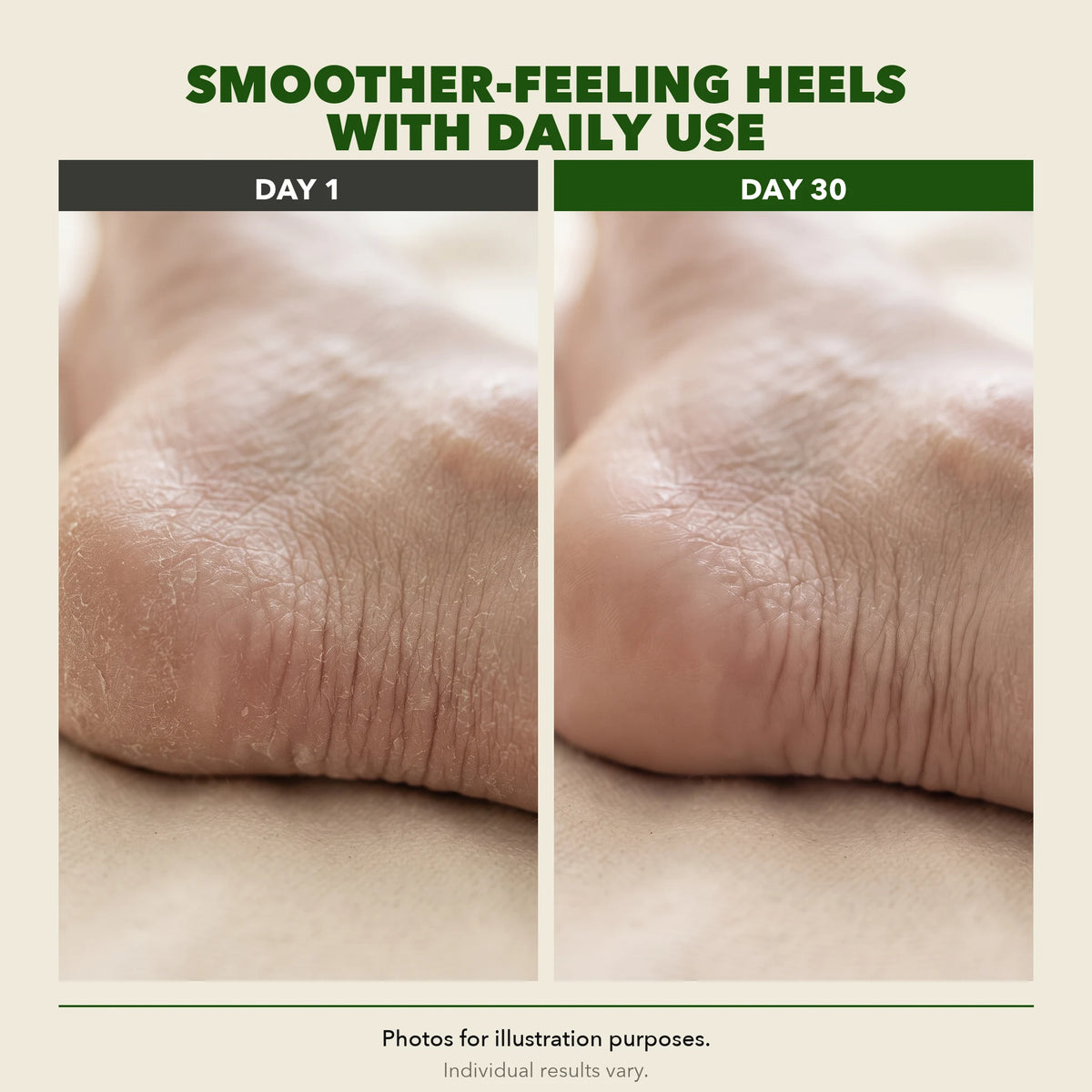 Day 1 and Day 30 comparison of heel skin texture, from dry and rough to smooth and hydrated. Photos for illustration purposes; individual results vary
