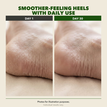 Day 1 and Day 30 comparison of heel skin texture, from dry and rough to smooth and hydrated. Photos for illustration purposes; individual results vary